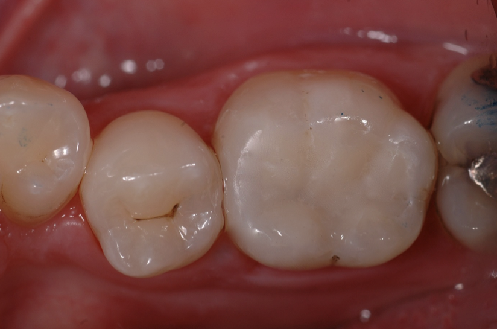 Amalgam Ersatz Kunststofffüllung: Ästhetik, Funktion und Mundgesundheit wurden verbessert.
