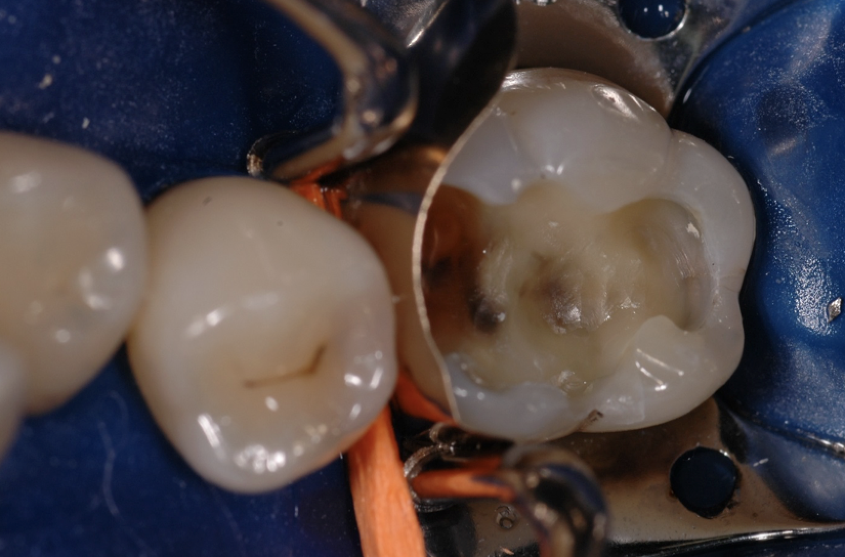 Amalgam entfernen Amalgam entfernt: Situation nach Entfernung der Füllung und absoluter Trockenlegung mit Kofferdam.