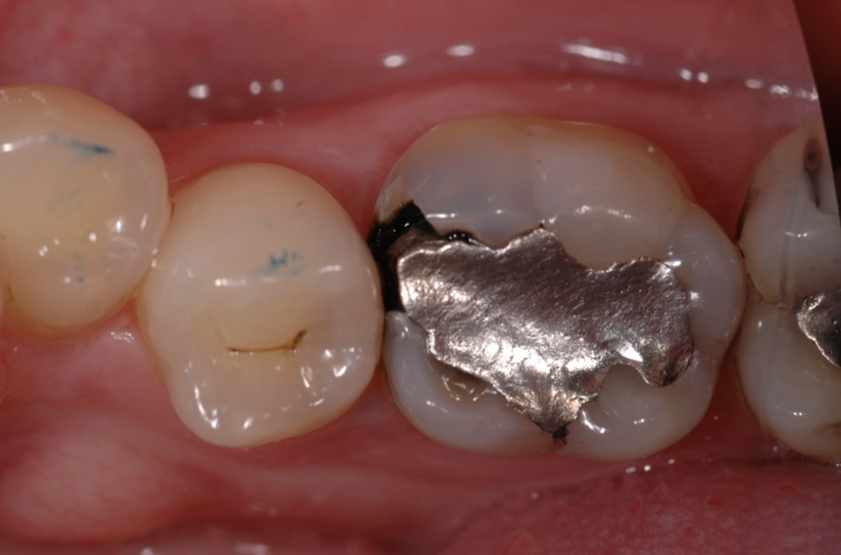 Amalgam Ausgangszustand: Undichte mittelgrosse Amalgam Füllung