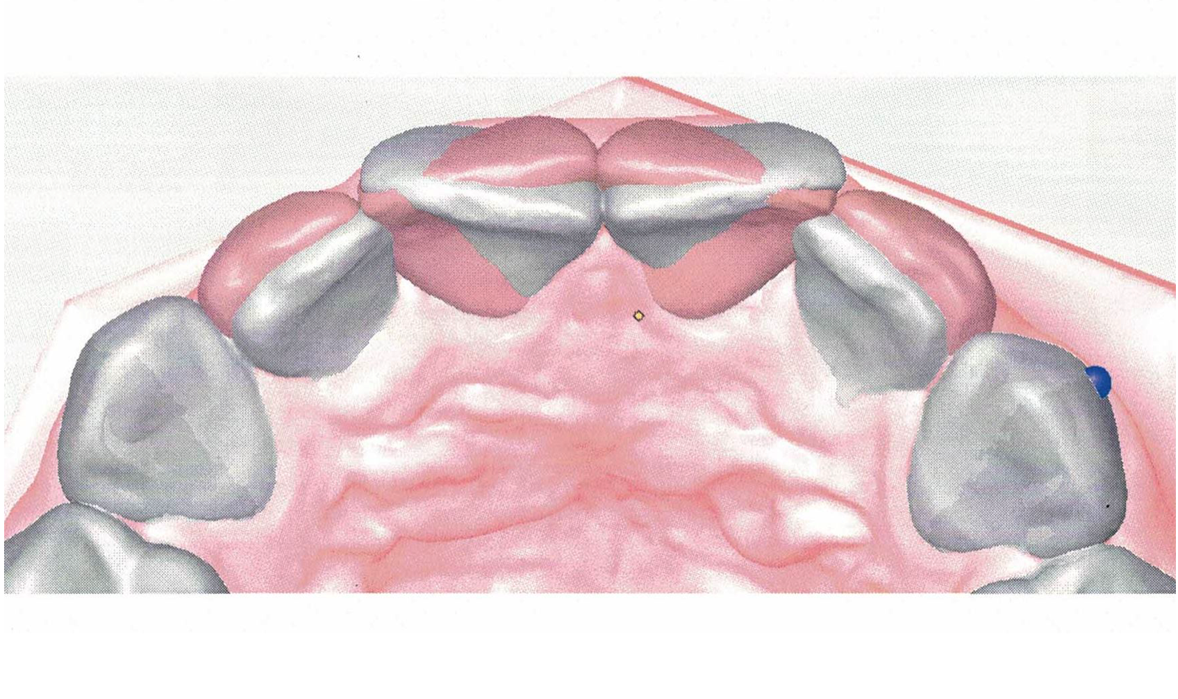 Durchsichtige Zahnspangen Digitale Planung und Simulation des Behandlungsergebnisses in einer speziellen Software