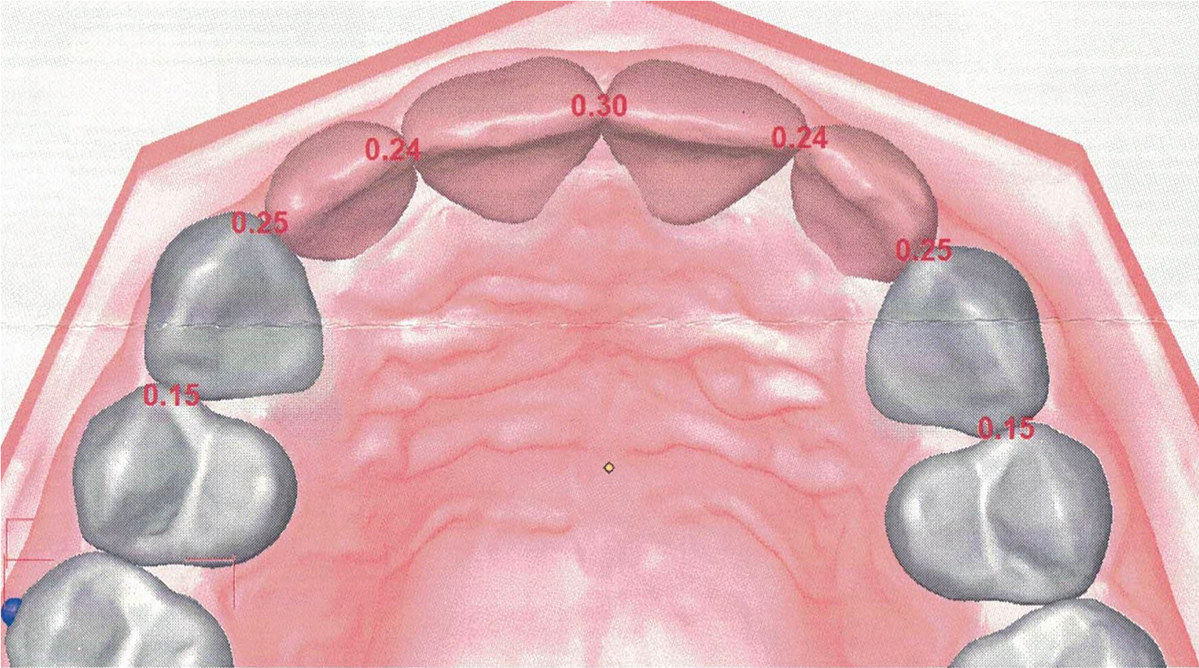 Durchsichtige Zahnspangen Digitale Planung und Simulation des Behandlungsergebnisses in einer speziellen Software