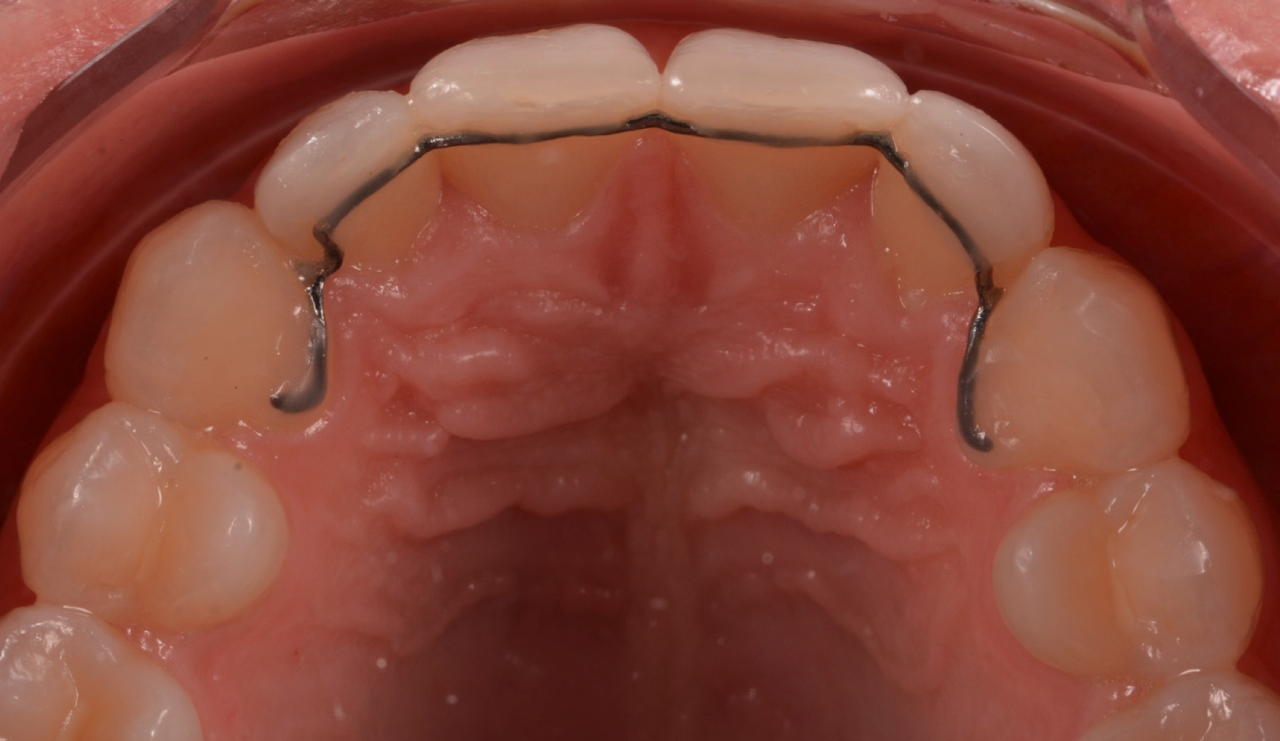 Durchsichtige Zahnspangen Die neue Position der Zähne wurden mit einem 3D gefrästen Titan-Retainer stabilisiert.