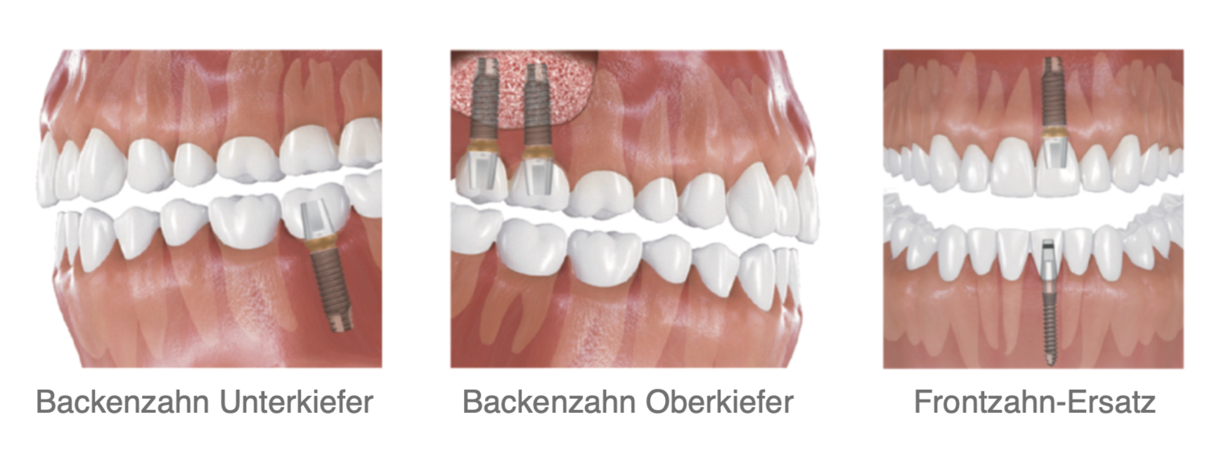 Implantate Anwendungen