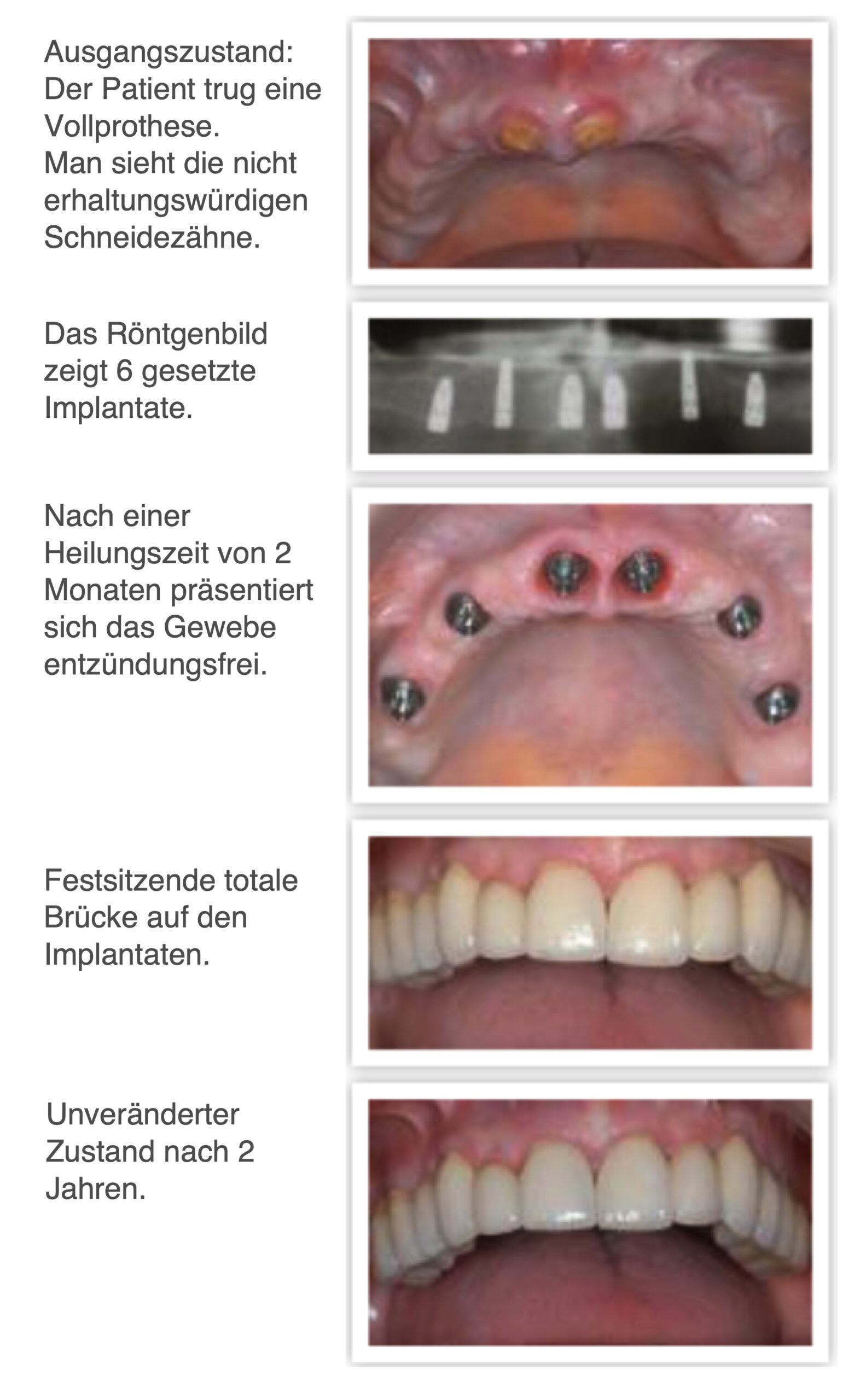 totale Brüecke