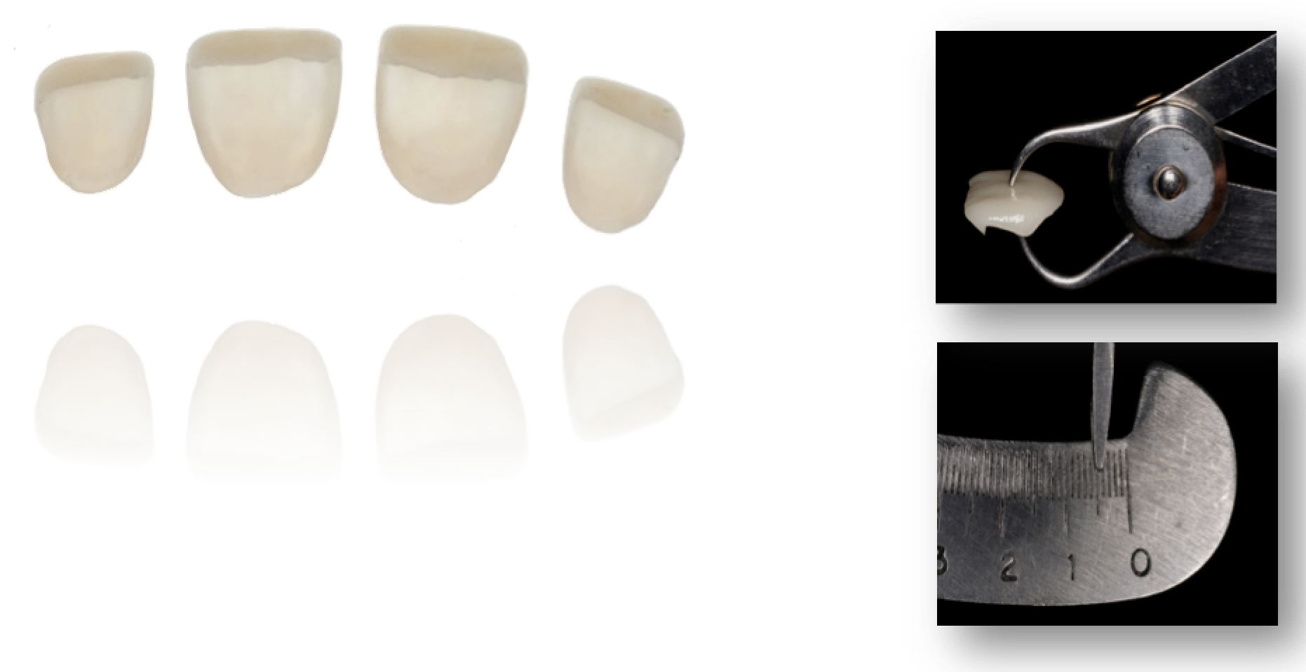 Veneers: Durchsicht Die Veneers im Durchsicht: Die Schalen vermögen gerade die dunklen Verfärbungen im Zahnhalsbereich abzudecken, ohne jedoch im Schneidekantenbereich allzu unnatürlich opak zu erscheinen. Keramik-Schalen von ca. 0.5 mm Dicke waren in diesem Fall die richtige Wahl.