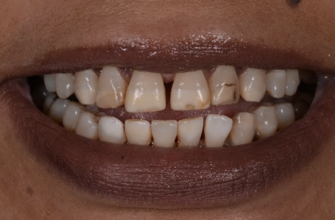 Veneers: vorher Ausgangssituation: Die Zähne sind aufgrund von Antibiotika Einnahme dunkel verfärbt.